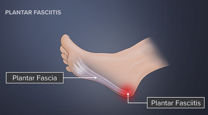 Plantar fasciitis-The Heel pain